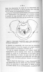 Figure 6. Utérus double. Hématométrie gauche. Coupe schématique de l'utérus et du bassin (Werth) - E [...]