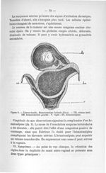 Figure 9. Utérus double. Hématométrie latérale (Fuld) - Exposé des titres et travaux