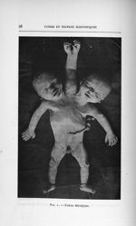 Fig. 1. Foetus dérodyme - Concours d'agrégation des facultés de médecine, 1904, section de chirurgie [...]