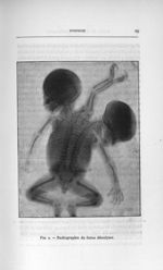Fig. 2. Radiographie du foetus dérodyme - Concours d'agrégation des facultés de médecine, 1904, sect [...]