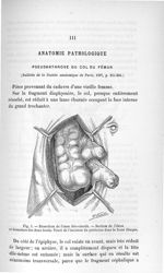 Fig. 5. Résection de l'anse iléo-caecale. - Section de l'iléon et fermeture des deux bouts. Tracé de [...]