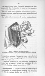Fig. 6. Résection de l'anse iléo-caecale. Décollement du caecum de la fosse iliaque. Tracé des incis [...]