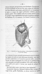 Fig. 7. Résection de l'anse iléo-caecale. - Reconstitution du péritoine de la fosse iliaque - Titres [...]