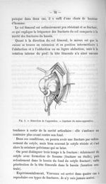 Fig. 8. Résection de l'appendice. - Ligature du méso-appendice - Titres et travaux scientifiques