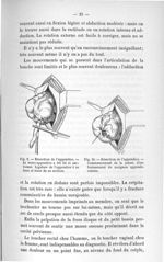 Fig. 9. Résection de l'appendice. - Le méso-appendice a été lié et sectionné. Ligature de l'appendic [...]