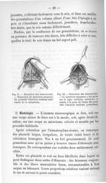 Fig. 11. Résection des hémorroïdes. - Dissection du manchon muqueux / Fig. 12. Résection des hémorro [...]