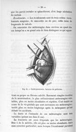 Fig. 15. Cholécystectomie. Incision du péritoine - Titres et travaux scientifiques
