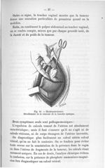Fig. 16. Cholécystéctomie. Décollement de la vésicule de la fossette cystique - Titres et travaux sc [...]