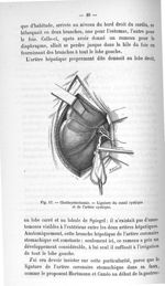 Fig. 17. Cholécystectomie. - Ligature du canal cystique et de l'artère cystique - Titres et travaux  [...]