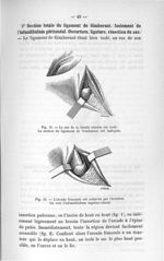 Fig. 18. Le sac de la hernie crurale est isolé. La section du ligament du Gimbernat est indiquée / F [...]