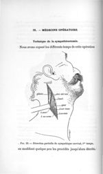 Fig. 23. Résection partielle du sympathique cervical, 1er temps - Titres et travaux scientifiques