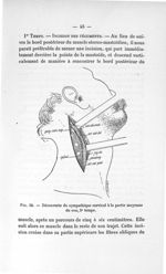 Fig. 24. Découverte du sympathique cervical à la partie moyenne du cou, 2e temps - Titres et travaux [...]