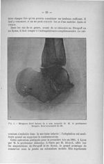 Fig. 5. Moignon droit datant de 4 ans (amputé de M. le Professeur Berger). Renversement de 18° - Tit [...]