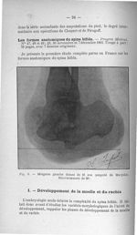 Fig. 6. Moignon gauche datant le 36 ans (amputé de Marjolin). Renversement de 20° - Titres et travau [...]