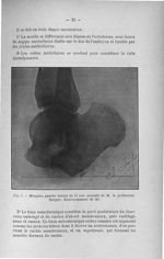Fig. 7. Moignon gauche datant de 11 ans (amputé de M. le Professeur Berger). Renversement de 30° - T [...]