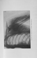 Luxation de l'épaule en arrière (observation I) - Concours pour l'agrégation, 1904, section de patho [...]