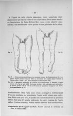 Fig. I. Déformations rachitiques des jambes (enfant de l'observation II) / Fig. II. Membres inférieu [...]