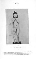 Fig. 1. G... Anne, 10 ans (cas de dyschondroplasie) - Concours pour l'agrégation, 1904, section de c [...]
