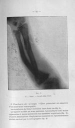 Fig. 5. G... Anne. - Avant-bras droit - Concours pour l'agrégation, 1904, section de chirurgie et ac [...]