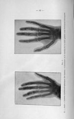 Fig. 6. G..., Anne. - Lésion dyschondroplasiques des mains. - L'annulaire et le médius de la main ga [...]