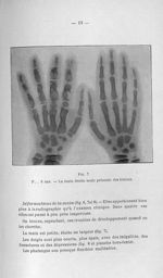 Fig. 7. P... 6 ans. - La main droite seule présent des lésions - Concours pour l'agrégation, 1904, s [...]