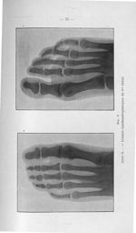 Fig. 9. Anne G... - Lésions dyschondroplasiques du 5me orteil - Concours pour l'agrégation, 1904, se [...]