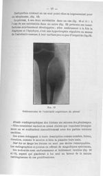 Fig. 13. Ostéosarcome de l'extrémité supérieure du péroné - Concours pour l'agrégation, 1904, sectio [...]
