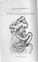 Fig. 14. Hernie périduodénale droite - Concours pour l'agrégation, 1904, section de chirurgie et acc [...]