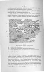 Fig. 15. Hypertrophie maligne de la prostate - Concours pour l'agrégation, 1904, section de chirurgi [...]