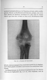Fig. 16. Fracture de l'épicondyle - Titres et travaux scientifiques