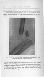 Fig. 17. Fracture sus-condylienne transversale (type classique), avec saillie en arrière du fragment [...]