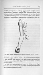 Fig. 23. Cubitus valgus à la suite d'une fracture du condyle externe - Titres et travaux scientifiqu [...]