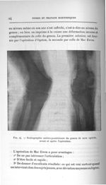 Fig. 14. Radiographie antéro-postérieure du genou de mon opérée, avant et après l'opération - Titres [...]