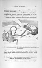 Fig. 16. L'anesthésiste donne de l'air au patient en faisant bâiller la partie supérieure de l'obtur [...]