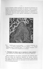 Fig. 4. Syphilis post conceptionnelle - Concours pour l'agrégation, 1904, section de chirurgie et ac [...]
