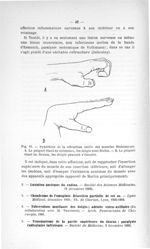 Fig. 15. Syndrôme de la rétraction isolée des muscles fléchisseurs - Concours pour l'agrégation, 190 [...]