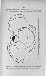 Fig. IV. Bassin asymétrique à deux diamètres d'engagement - Concours pour l'agrégation, 1904, sectio [...]