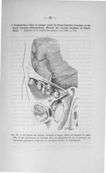 Fig. 12. La hernie du caecum derrière le fascia iliaca est figurée en pointillé et sort au-dessous d [...]