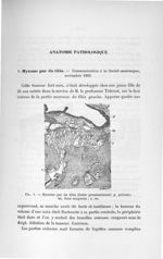 Fig. 1. Myxome pur du tibia (faible grossissement) - Concours d'agrégation de chirurgie et d'accouch [...]