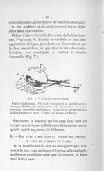 Fig. V. Traction unilatérale - Concours pour l'agrégation, 1904, section de chirurgie et d'accouchem [...]