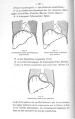 Fig. 6. Constriction haute (sus-hépatique) type féminin / Fig. 7. Constriction haute (hépatique) typ [...]