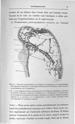Fig. 14. Fracture longitudinale du cartilage de conjugaison avec aplatissement de l'épiphyse et frac [...]