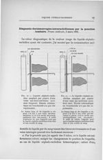 Fig. 10. Liquide céphalo-rachidien sanglant par piqûre d'une veine sus-dure-mérienne (accident fréqu [...]
