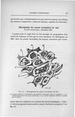 Fig. 15. Histogénèse du cancer secondaire du foie - Titres et travaux scientifiques