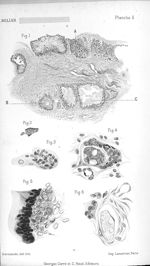 [Hygromas calcifiés et granulomes calcaires sous-cutanés] Fig. 1. Coupe histologique vue à un faible [...]