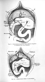 Fig. 9. Gastro-jéjuno-anastomose après ligature du pylore et formation d'un anus duodénal / Fig. 10. [...]