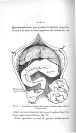 Fig. 11. Anastomose duodéno-iléale après exclusion quasi-totale de l'intestin grêle - Titres et trav [...]