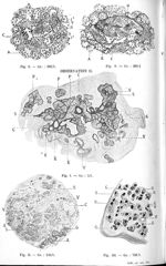 Fig. 8. Morcellement de l'îlot de Langerhans et dégénérescence hyaline des cellules insulaires. Obse [...]