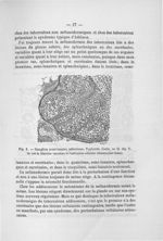 Fig. 8. Ganglion semi-lunaire infectieux. Typhoïde - Addenda aux titres scientifiques