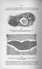 Fig. 2. Trois cellules du 2me ganglion sympathique cervical ; à gauche, tubercule rabique circonscri [...]